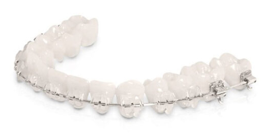 Ceramic Advanced Clarity Braces - frederick street dental care